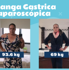 Caso de Éxito, Manga Gástrica Laparoscópica